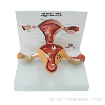 Modelo de útero com patologia